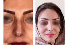 جراحی-بینی-سمنان-119