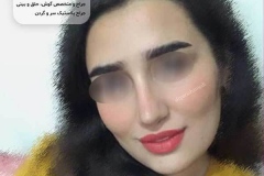 جراحی-بینی-سمنان-94