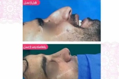جراحی-بینی-سمنان-96