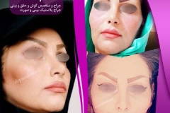 جراحی-بینی-27