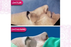 سمپل