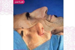 جراحی-بینی-68