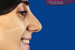 جراحی-بینی-77