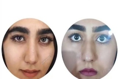 rhinoplasty-130