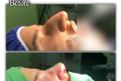 rhinoplasty-132