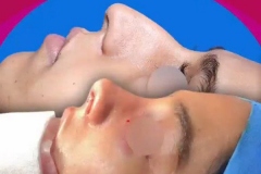 rhinoplasty-133