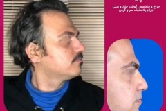 rhinoplasty-137