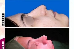 rhinoplasty-138