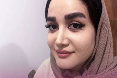 rhinoplasty-139