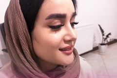 rhinoplasty-140