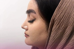 rhinoplasty-141