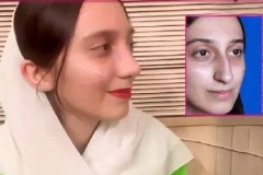 rhinoplasty-146