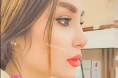 rhinoplasty-148