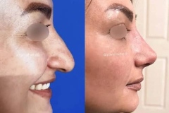 rhinoplasty-150