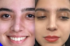rhinoplasty-152
