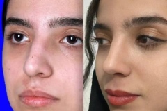rhinoplasty-153