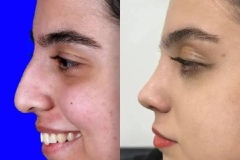 rhinoplasty-154