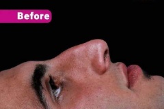 rhinoplasty-155