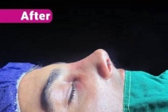 rhinoplasty-156-1