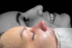rhinoplasty-160