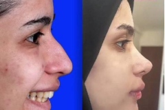 rhinoplasty-161