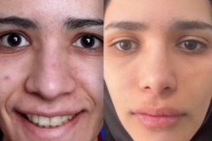rhinoplasty-162