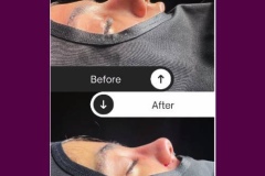 rhinoplasty-167-2