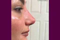 rhinoplasty-168