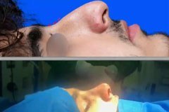 rhinoplasty.127