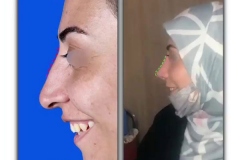 rhinoplasty.jpg124