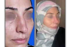 rhinoplasty.jpg125