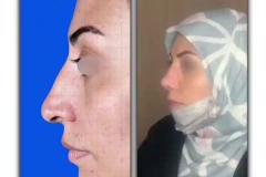 rhinoplasty.jpg126