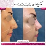 جراحی بینی استخوانی