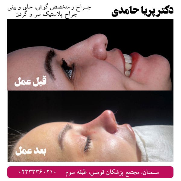 نمونه کار عمل بینی دکتر حامدی