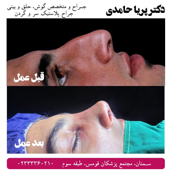 نمونه کار عمل زیبایی بینی دکتر حامدی