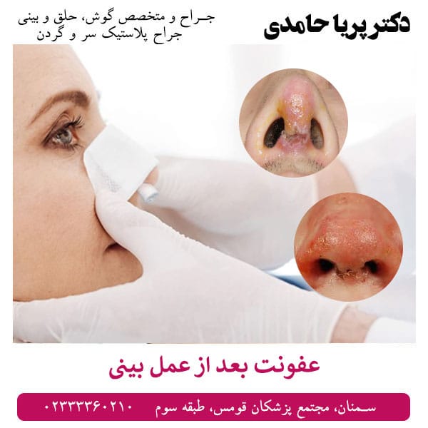 عفونت بعد از عمل بینی