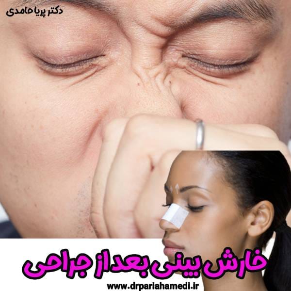 خارش بینی بعد جراحی - دکتر پریا حامدی