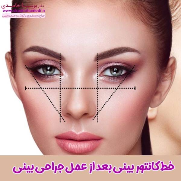 خط کانتور بینی بعد عمل - دکتر پریا حامدی